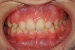 %e4%b8%8b%e9%a1%8e%e5%be%8c%e9%80%80%e9%99%a4%e5%8e%bb