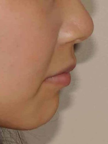 非対称 唇 左右 顔の左右非対称は治せる！効果的なマッサージとメイク方法 ｜